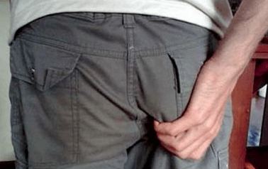 prurito all'ano come sintomo della presenza di parassiti