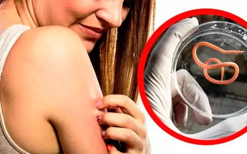 prurito e irritazione dovuti a parassiti nel corpo