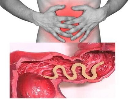 segni di elmintiasi cronica sono disturbi intestinali dispeptici