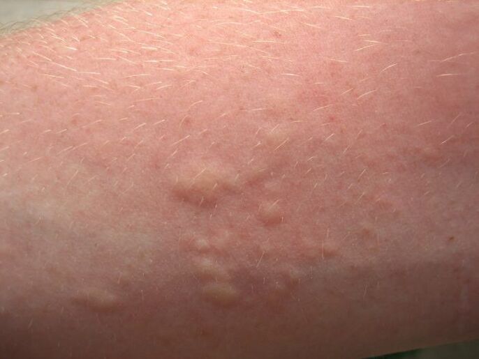 eruzioni cutanee allergiche pruriginose possono essere sintomi di ascariasi