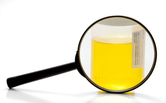 Esame delle urine per diagnosticare la schistosomiasi