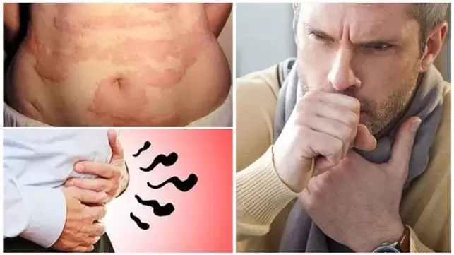 Allergie, tosse e gonfiore sono segni di danni al corpo da parte dei vermi